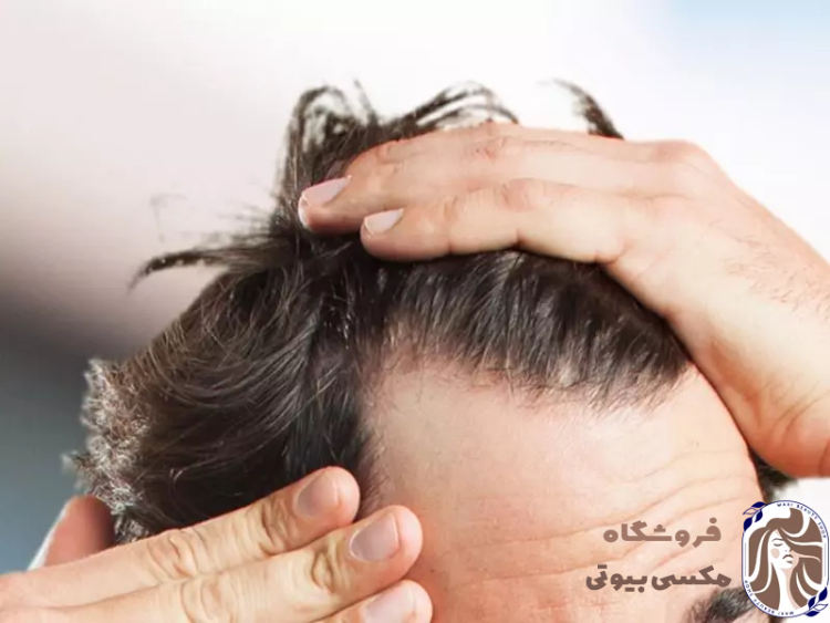 علت ریزش ناگهانی موی سر و راه حل آن