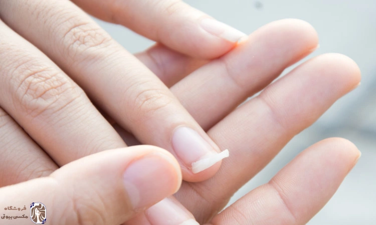 درمان خانگی شکستن ناخن