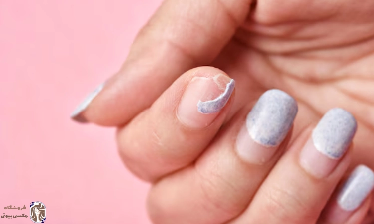 درمان شکستن ناخن